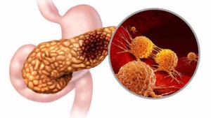 Stomach cancer warning: Vitamin A deficiency may increase your risk; know key symptoms